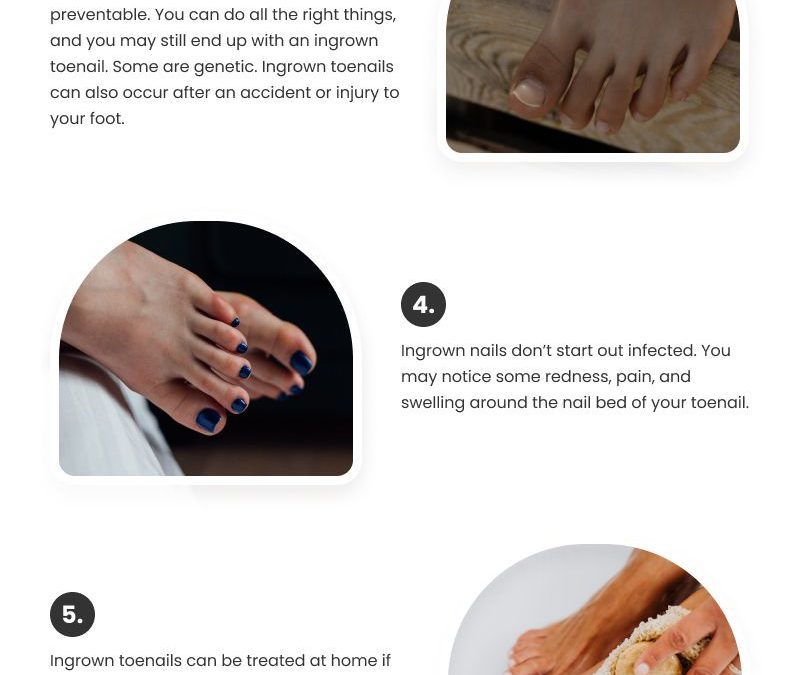 10 Things You Should Know About Ingrown Toenails